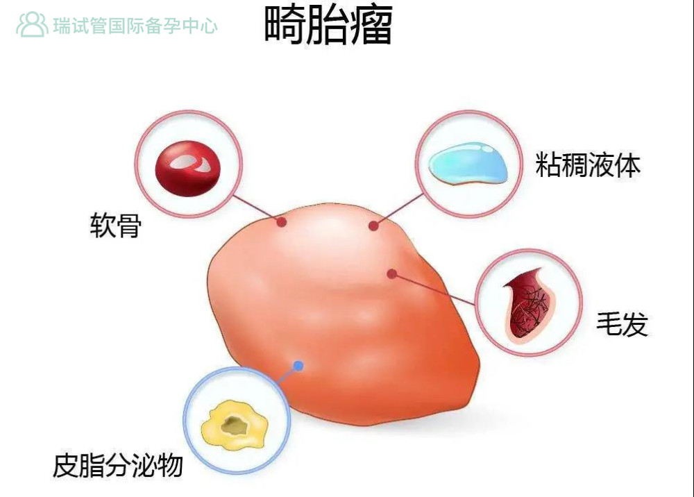 卵巢囊肿会不会影响怀孕 腾讯新闻