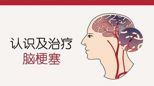 脑梗塞早期的症状有哪些 它和脑中风是一回事吗 腾讯新闻