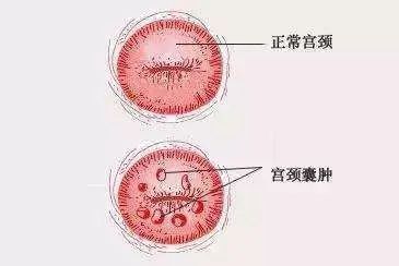 大部分的宫颈纳囊体积比较小,而且单发或者散发,大多数没有临床症状的