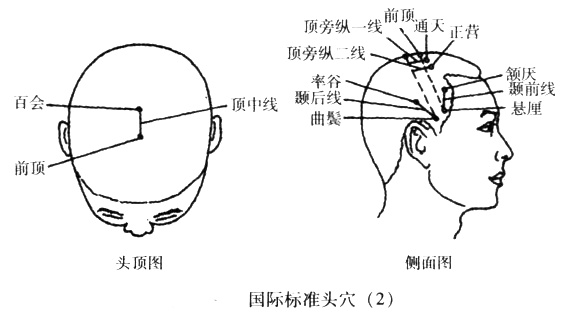 【取穴】取穴对侧顶颐前斜线和顶颖后斜线上1/3,顶旁l线,顶中线.