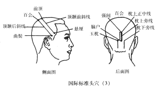 【取穴】取穴对侧顶颐前斜线和顶颖后斜线上1/3,顶旁l线,顶中线.