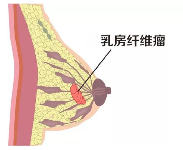 摸到乳房有肿块就是乳腺癌医生不一定可能是乳腺纤维腺瘤