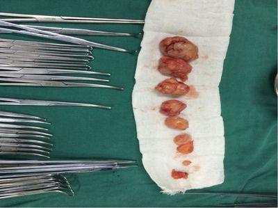 摸到乳房有肿块就是乳腺癌医生不一定可能是乳腺纤维腺瘤