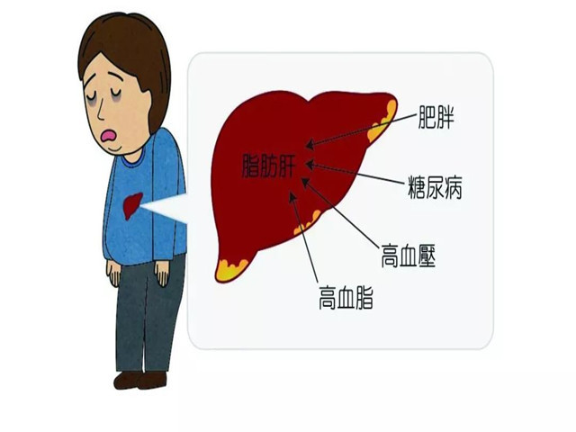 有脂肪肝不当回事当心拖成肝硬化医生告诫3种食物少碰