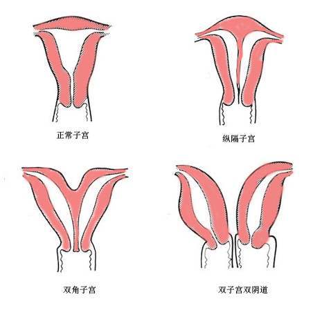 貝安:雙角子宮女性是否合適做試管嬰兒?