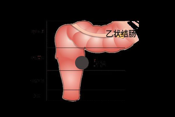 示意图直肠癌是指从齿状线至直肠乙状结肠交界处之间的癌.
