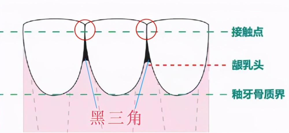 牙齿出现黑三角真不可逆的吗听听医生怎么说