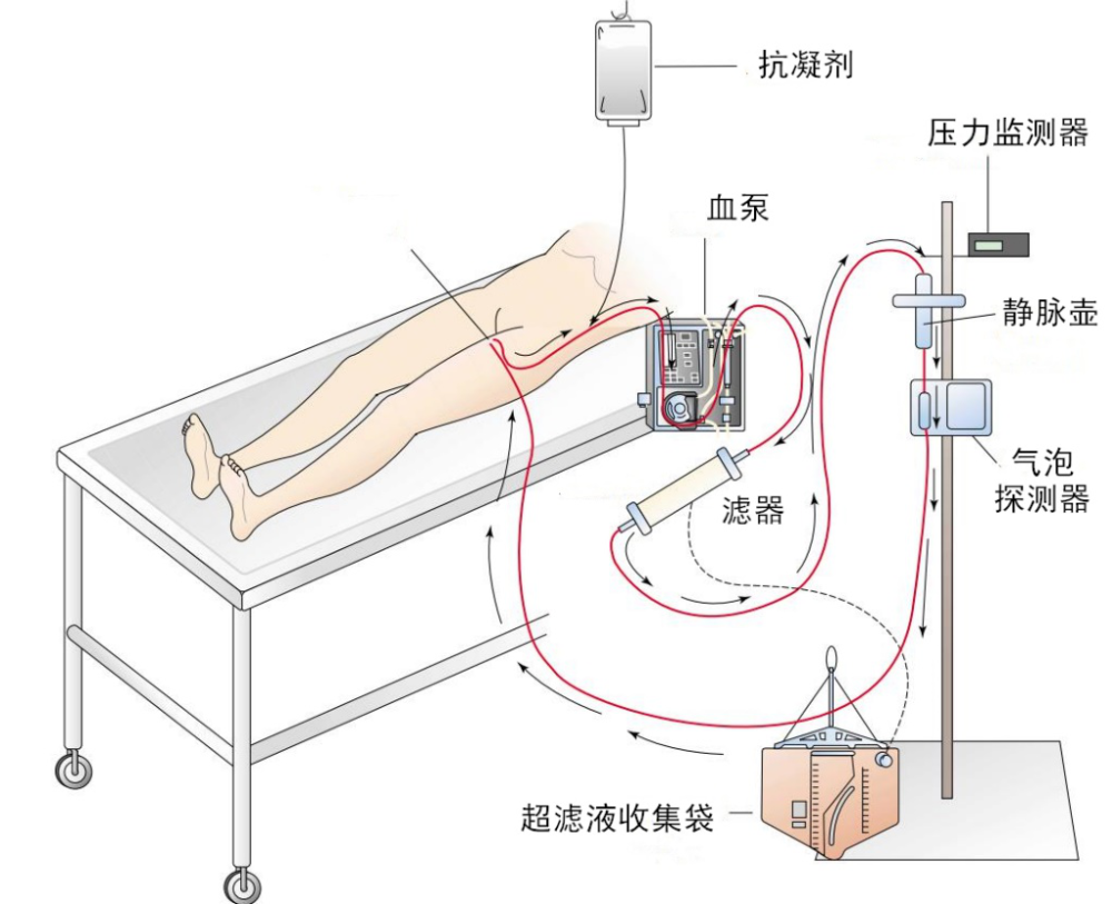 crrt包括连续性动静脉,静静脉血液滤过(cavh,cvvh,如图1),连续性动