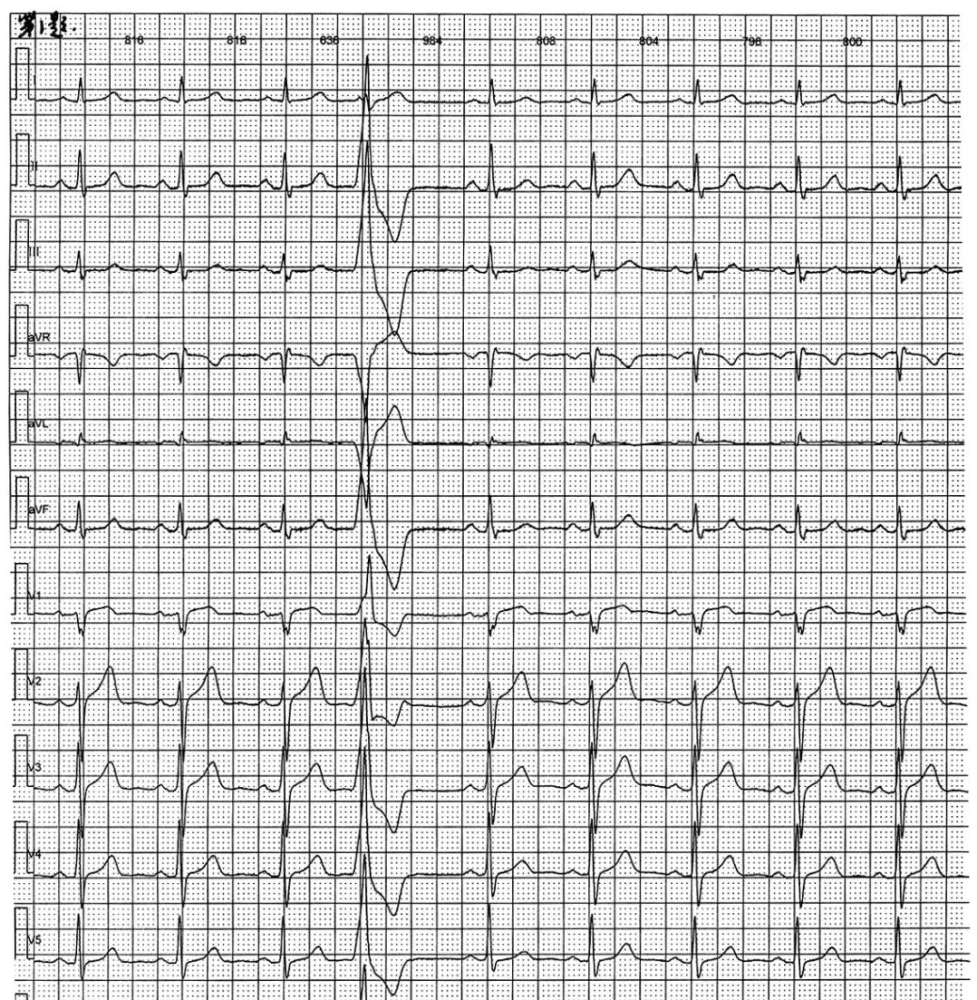 心电图读图每日一练,不断提高心电图诊断水平,第1题