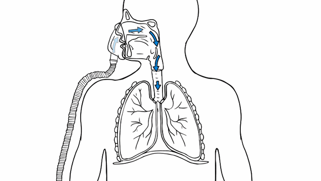解析无创呼吸机排二氧化碳的原理