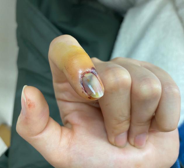 宋祖儿手被门夹到喷血食指乌黑太可怕妈妈却说像特效装