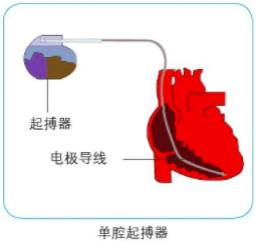 介入耗材前景无限迷你智能心脏起搏器的未来