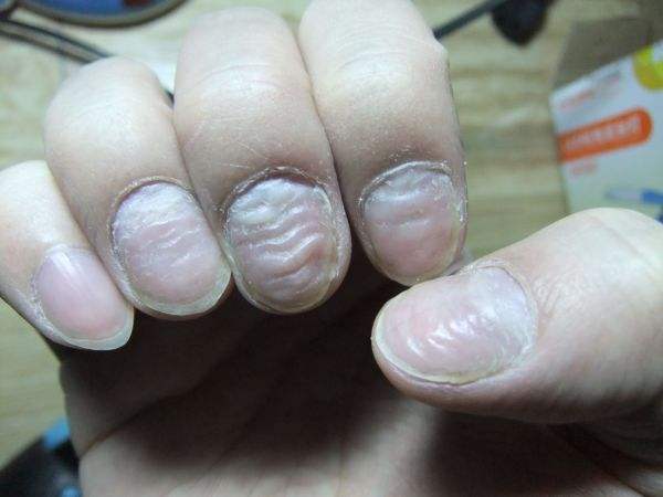 最有可能的就是指甲营养不良或者是灰指甲,甲板变薄,或是出现甲纵横纹