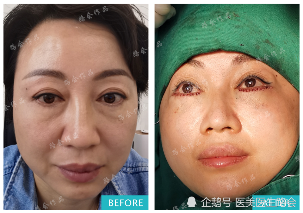 探真相3次祛眼袋手术为啥失败92天看她如何成功逆袭