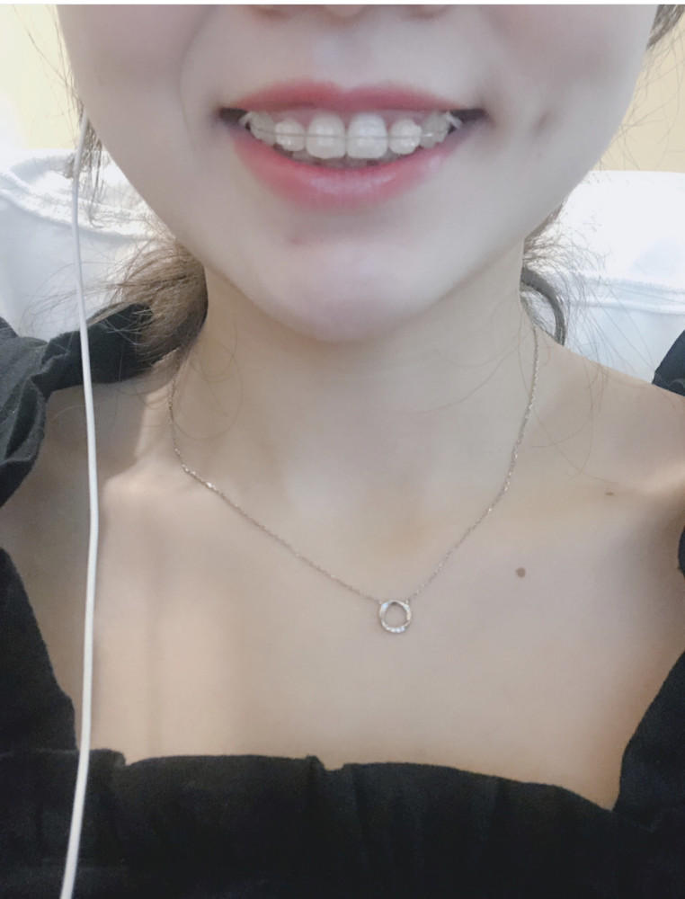 半隐形矫正,牙齿的变形计