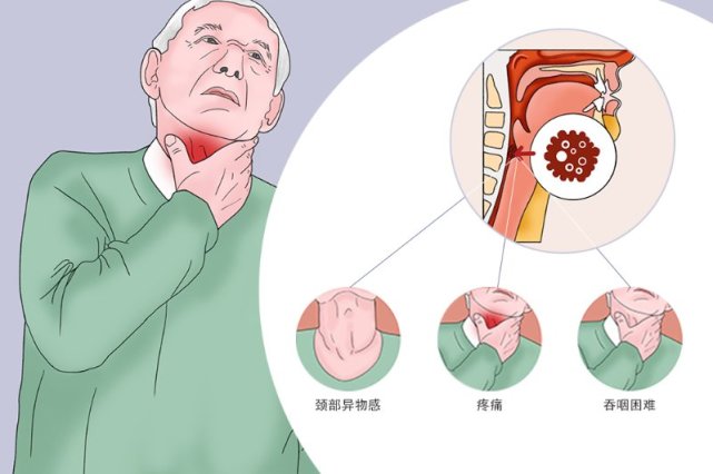 下咽癌是一种常见的头颈部的恶性肿瘤,因其主要症状