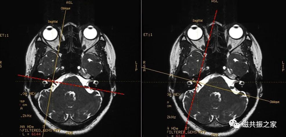 磁共振 Mri 内耳扫描技术 腾讯新闻