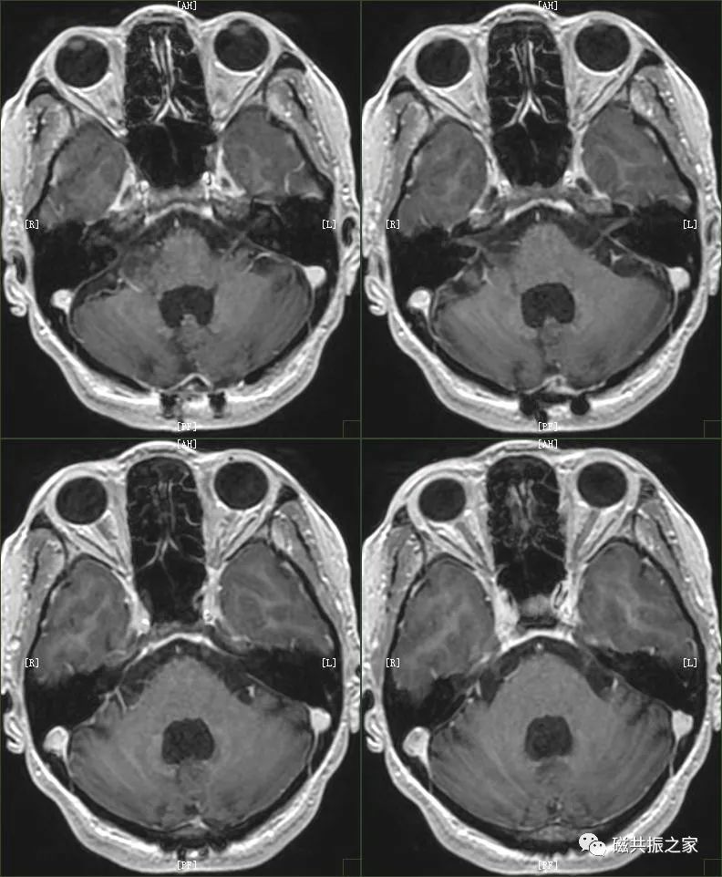 磁共振 Mri 内耳扫描技术 腾讯新闻