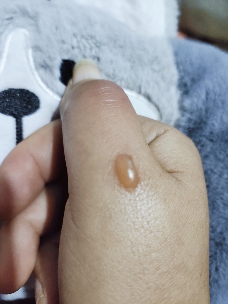 低温烫伤起个小水泡一查