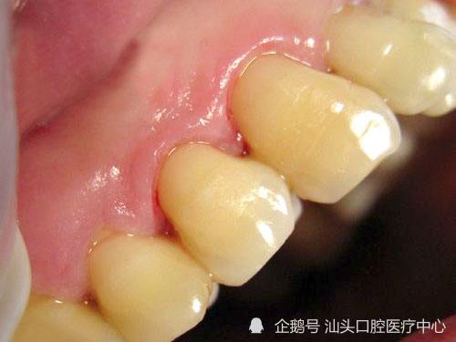 冷水漱口牙齿痛?酸甜入口受刺激?警惕楔状缺损!