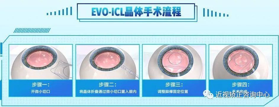 Icl晶体植入手术全攻略和指南 安全吗 腾讯新闻