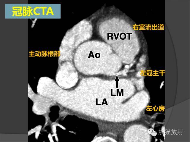 冠狀動脈系統解剖,cta解剖,分段及中英文名稱對照