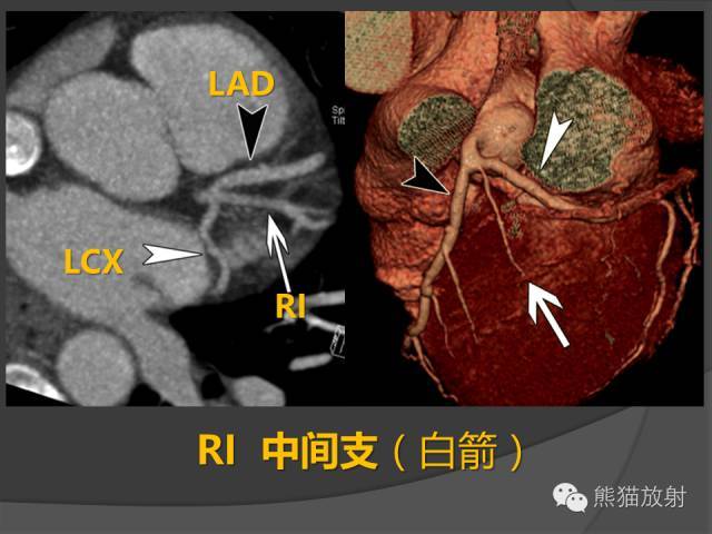 冠狀動脈系統解剖,cta解剖,分段及中英文名稱對照