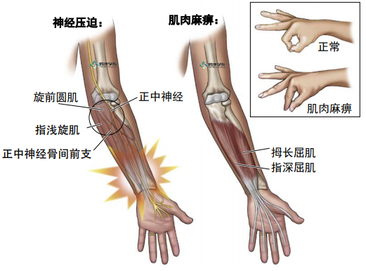 體格檢查會發現患者由於拇長伸肌腱和拇深深肌腱的麻痺不能彎曲拇指