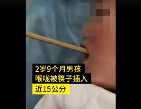 好险 2岁男童被筷子插入喉咙近15公分 关于筷子家长不得不知 腾讯网
