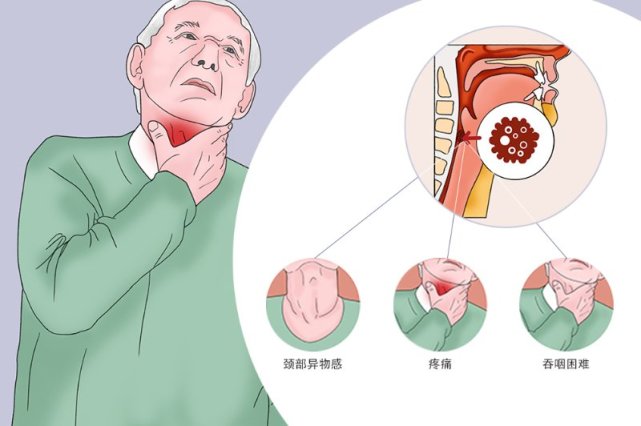 老觉得咽部有异物感?专家:警惕下咽癌|肿瘤|癌症|症状|吞咽困难|下咽