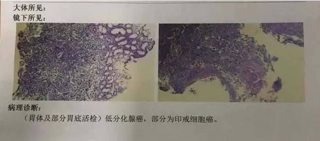 太狡猾太兇險這種胃癌有時竟連胃鏡都難以查出該怎麼辦