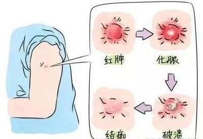 伤口护理要正确的护理,要防止伤口感染,做好消du,清创创面,可以使用