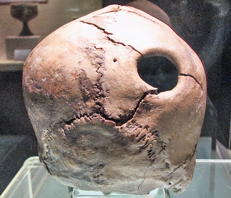 山东省博物馆的古怪文物,被开了个大洞的头颅,墓主生前怎么了?
