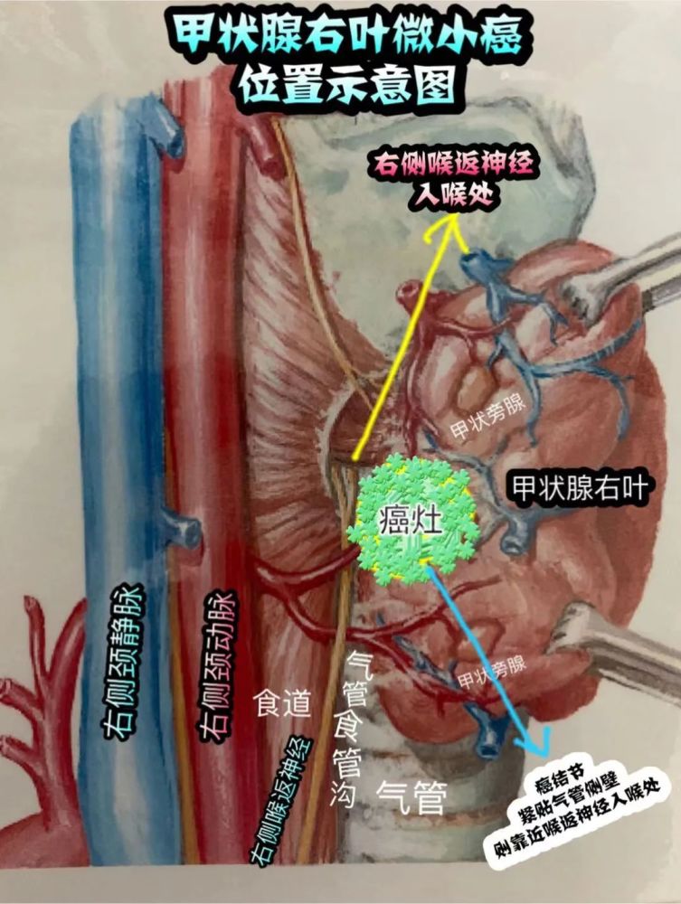 位置不好的甲状腺癌即使癌灶特别小也应该尽早手术