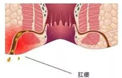 肛门腺受到感染时,粪便以及细菌会进入周围组织,从而诱发肛门脓肿