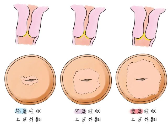 龚医生的建议是它只是宫颈柱状上皮受雌激素影响而产生外翻的一种表现