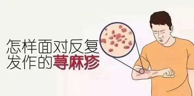 中醫二羊《打敗專家教授系列案》之慢性蕁麻疹四例