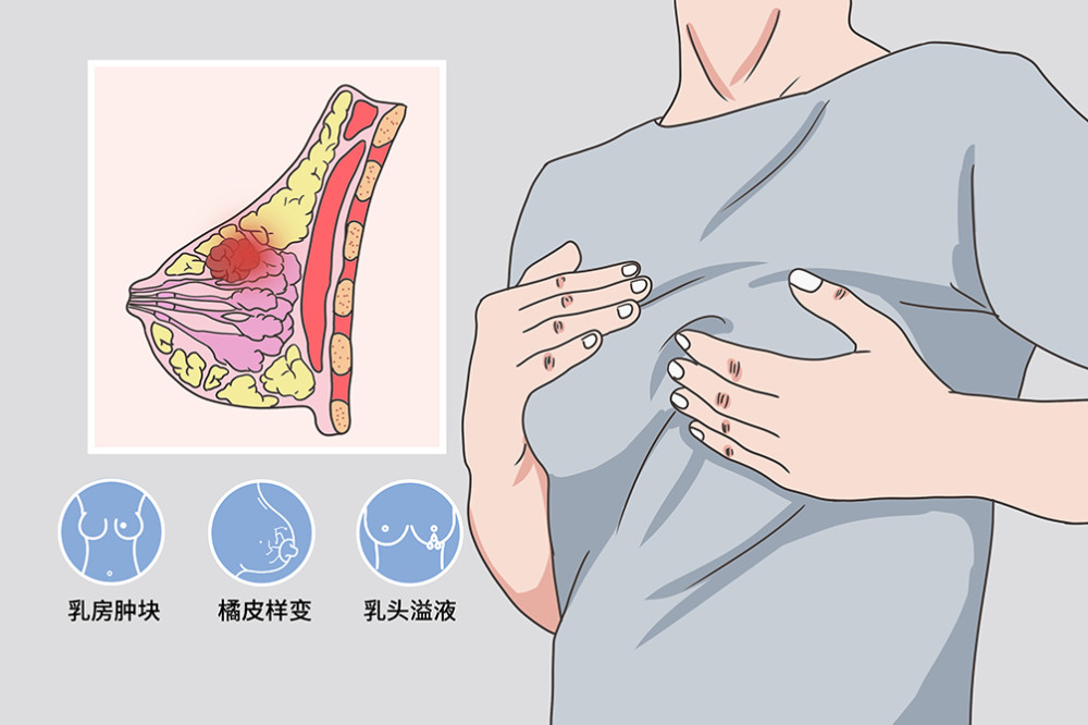 大多為乳房無