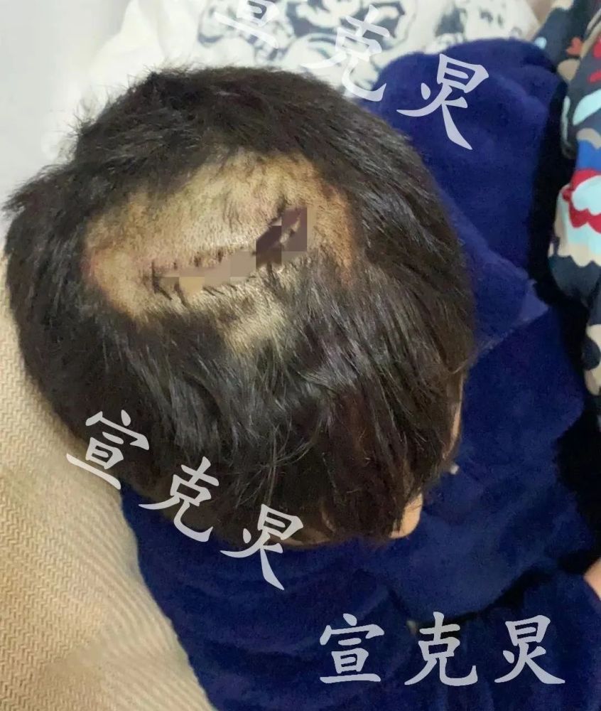 惊悚伤口8厘米沪公园滑梯存隐患小孩玩耍撞破头