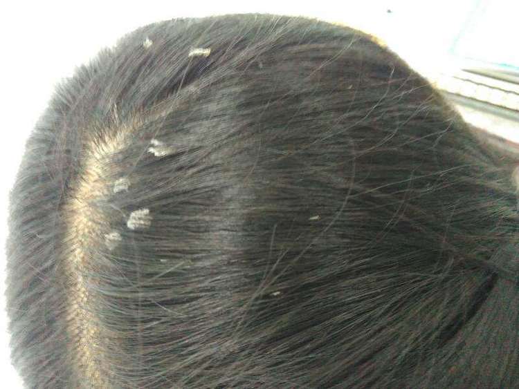 总是头皮发痒,有大块头屑咋办?