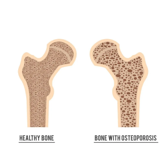 骨密度悄悄流失出现骨质疏松当心成为脆骨人