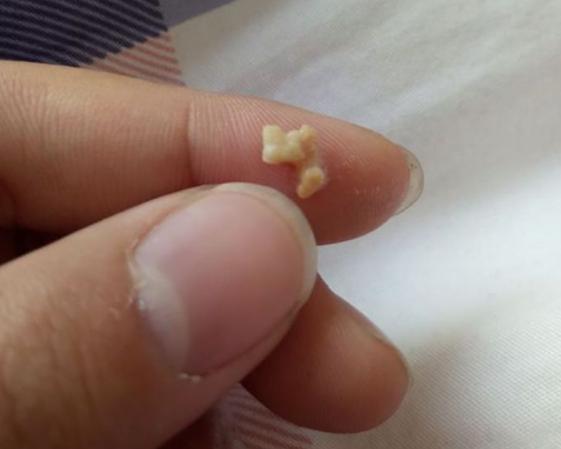 出来没回家,直接去了医院做检查,原来,孩子口臭是因为扁桃体长了结实