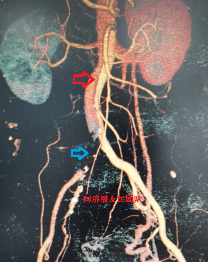 右髂总动脉闭塞(蓝箭头手术)进一步检查胸腹主动脉cta明确了主动脉