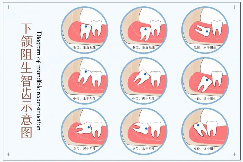 【科普】长了智齿该不该拔?这6类人别随意拔,严重时可危及生命…_腾