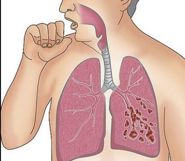 睡眠均有好转,临床症状改善,咳嗽减轻,痰量减少,肺内哮鸣音减少或消失