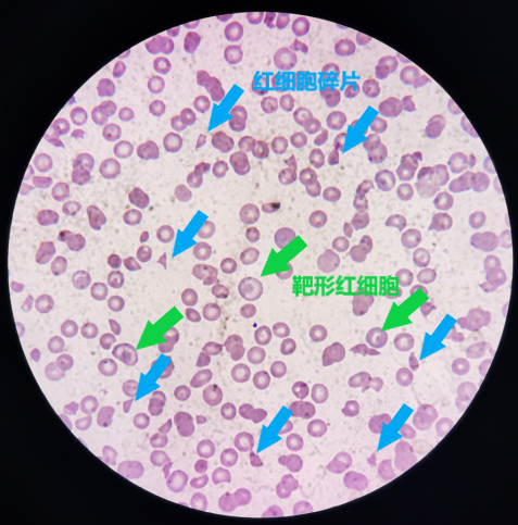 镜下结果血小板与网织红细胞通道结果基本一致,镜下还可见大量的细胞