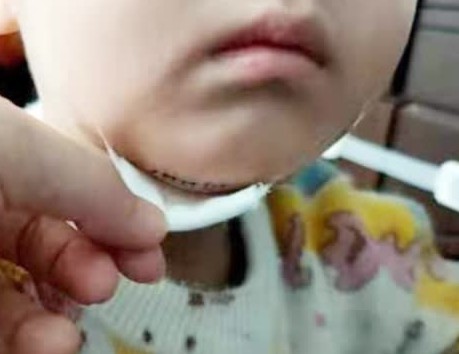 男童被幼师摔地上下巴缝8针 园方:可免除学费