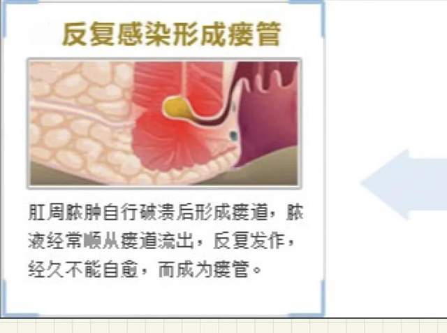 03如何治療肛周膿腫治療少數可用抗生素治療.