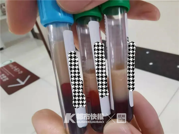 杭州40多岁老总被下属急送医院抽血抽出脂肪有这些习惯的朋友要当心