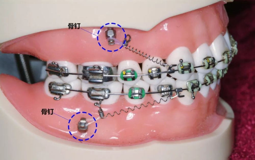 戴牙套 为什么要打骨钉 痛不痛 腾讯新闻